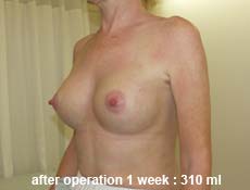 plastic-surgery-breast-augmentation 